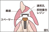 ケラターアタッチメント