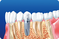 インプラント治療
