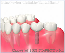 インプラント